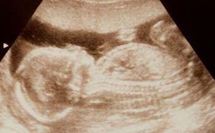 卵泡不破在山西做试管婴儿能成功吗，卵泡不破试管方案流程及成功率